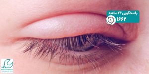 درمان خانگی ورم چشم